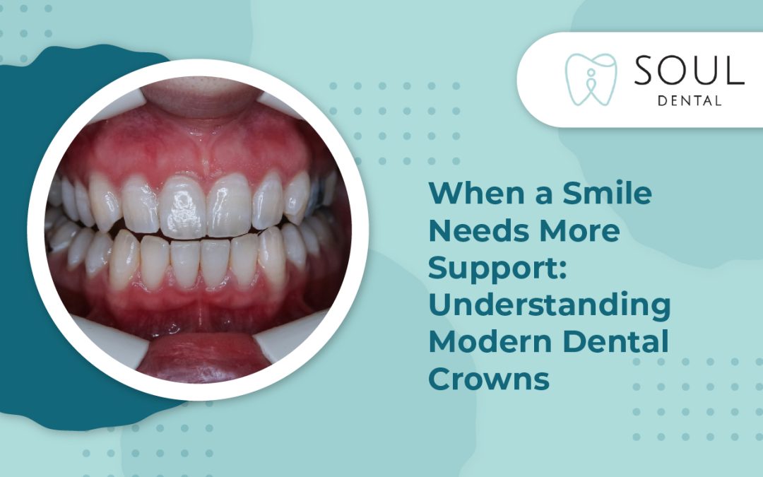 When a Smile Needs More Support: Understanding Modern Dental Crowns