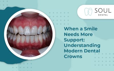 When a Smile Needs More Support: Understanding Modern Dental Crowns