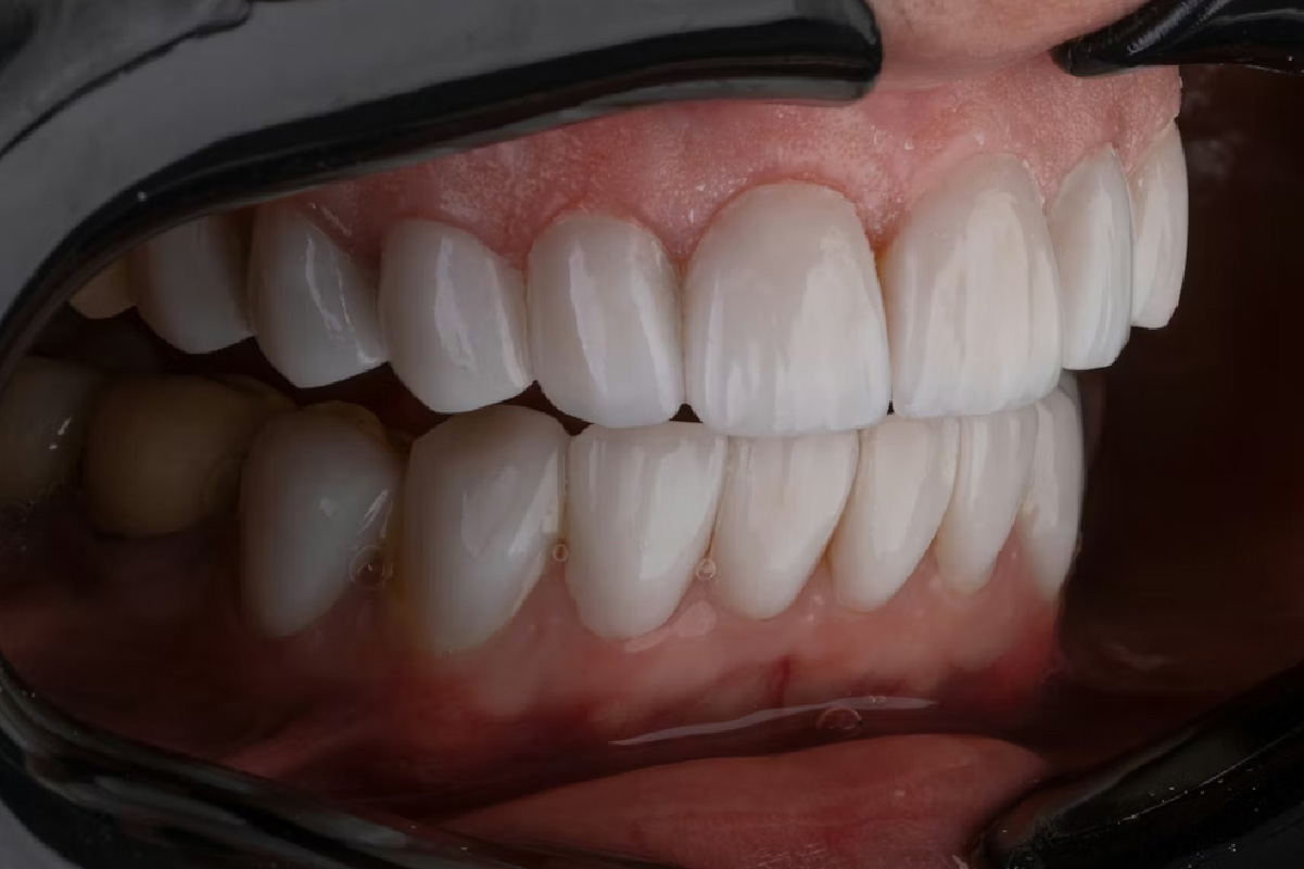 Professional scale and clean at Soul Dental Gold Coast