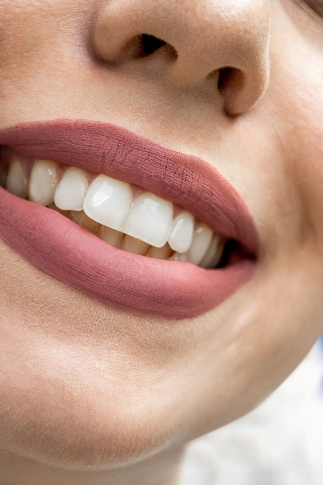 Smile makeover with veneers at Soul Dental Gold Coast